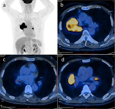 Conversion therapy from unresectable stage IIIC non-small-cell lung cancer to radical surgery via anti-PD-1 immunotherapy combined with chemotherapy and anti-angiogenesis: A case report and literature review